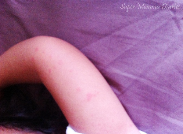 The onset of rashes on the Little Princess' arms. It spread to her body, back, thighs and even her nape. Poor little girl! :(